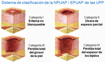 Úlceras por presión