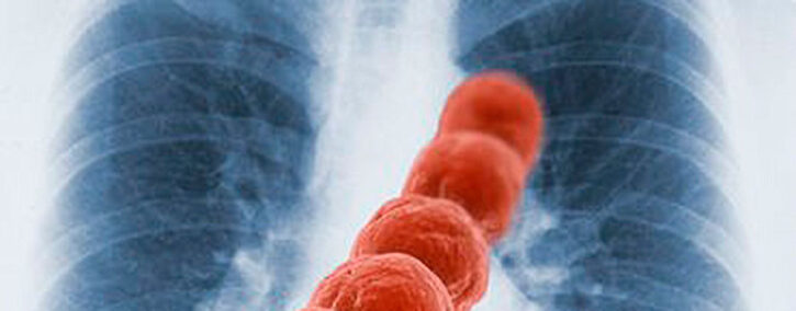 neumonia-aspirativa